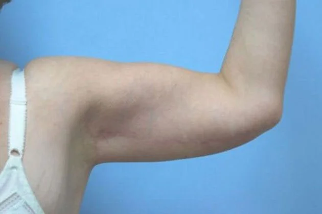 Body Contouring — After