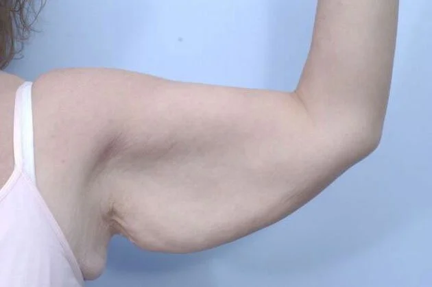 Body Contouring — Before
