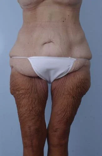 Body Lift / Extended Tummy Tuck — Before