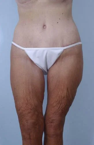 Body Lift / Extended Tummy Tuck — After