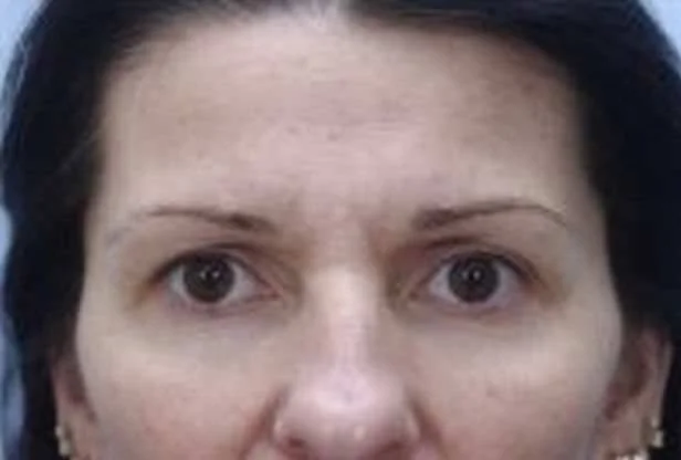 Brow Lift — Before
