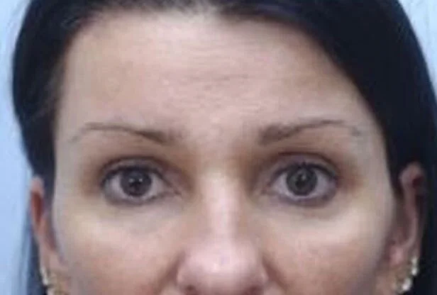 Brow Lift — After