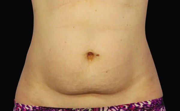 CoolSculpting — Before