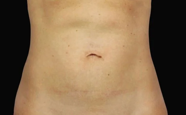 CoolSculpting — After
