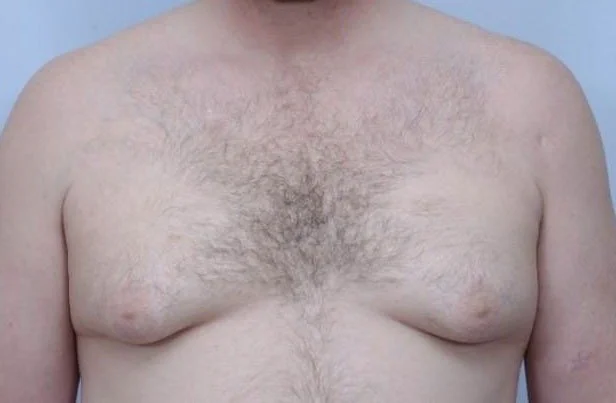 Gynecomastia — Before