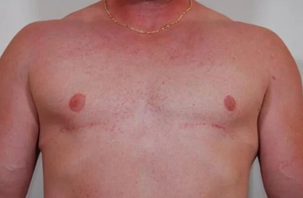 Gynecomastia — After