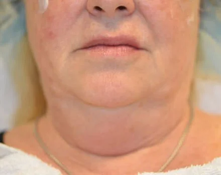 Kybella — Before