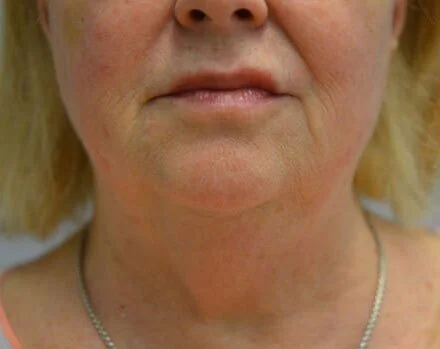 Kybella — After