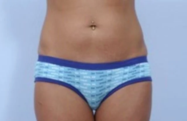 Mini Tummy Tuck — Before