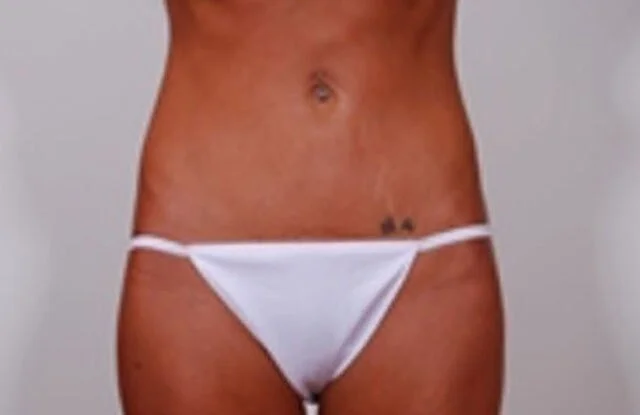 Mini Tummy Tuck — After
