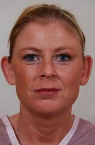 Otoplasty — Before