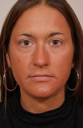 Rhinoplasty — Before