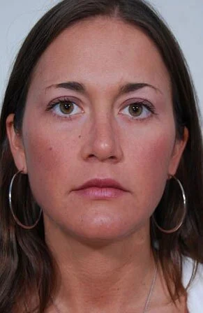Rhinoplasty — After