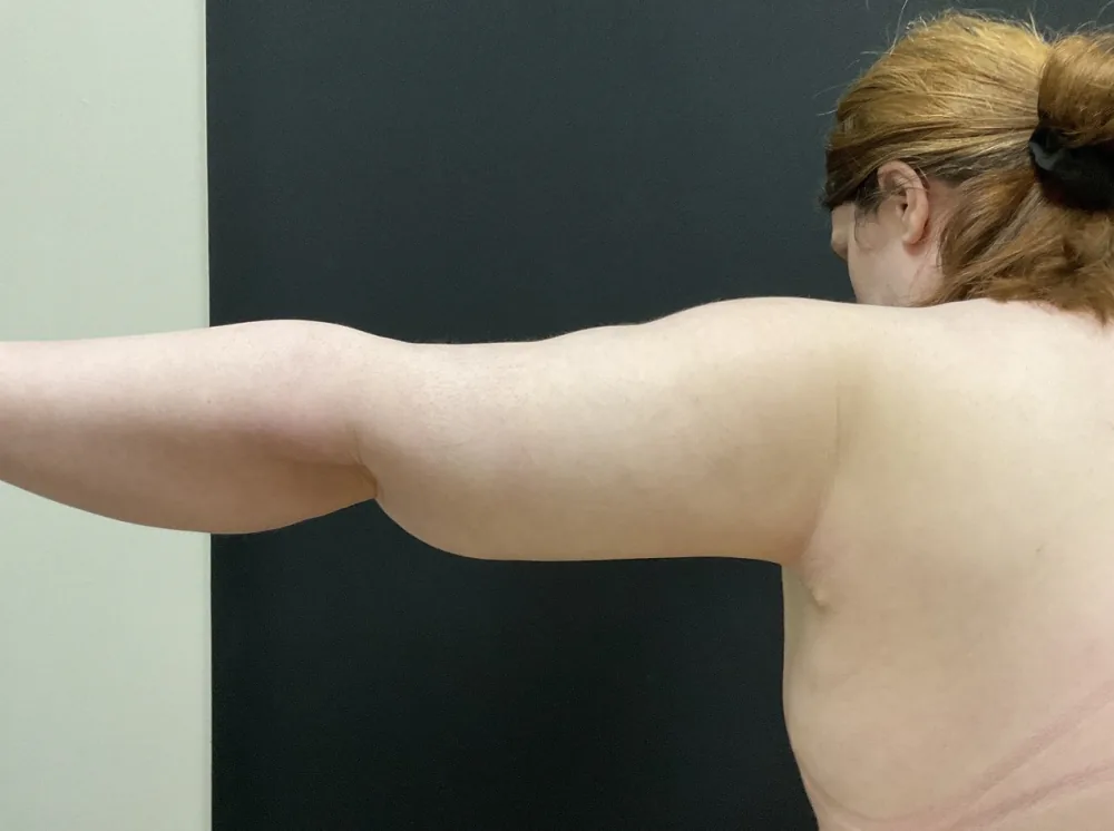 Arm Lift (Brachioplasty) after — Dr. John Aker