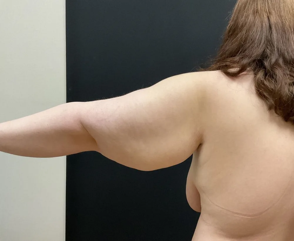 Arm Lift (Brachioplasty) before — Dr. John Aker
