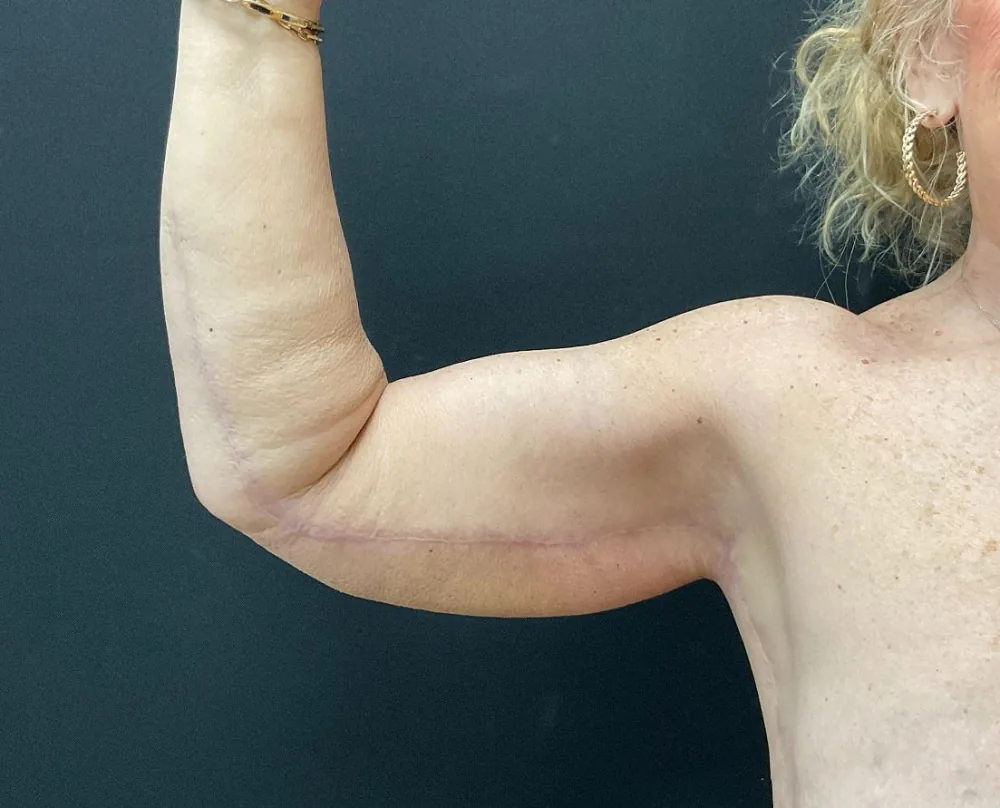 Arm Lift (Brachioplasty) after — Dr. John Aker
