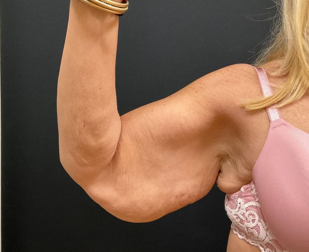 Arm Lift (Brachioplasty) before — Dr. John Aker