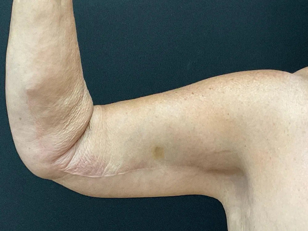 Arm Lift (Brachioplasty) after — Dr. John Aker