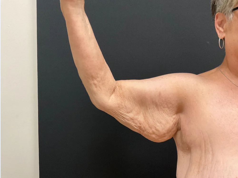 Arm Lift (Brachioplasty) before — Dr. John Aker