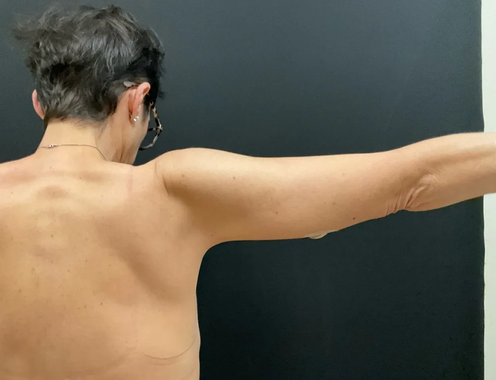 Arm Lift (Brachioplasty) after — Dr. John Aker