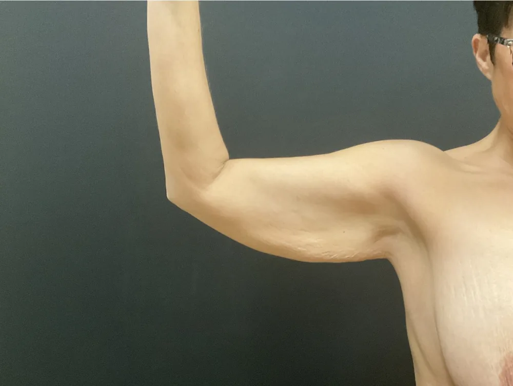 Arm Lift (Brachioplasty) before — Dr. John Aker