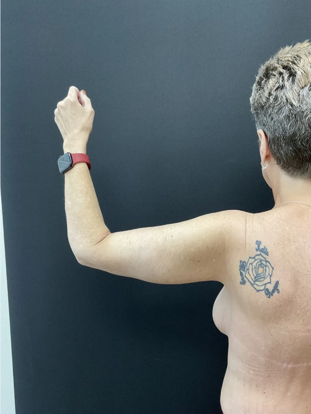 Arm Lift (Brachioplasty) after — Dr. John Aker