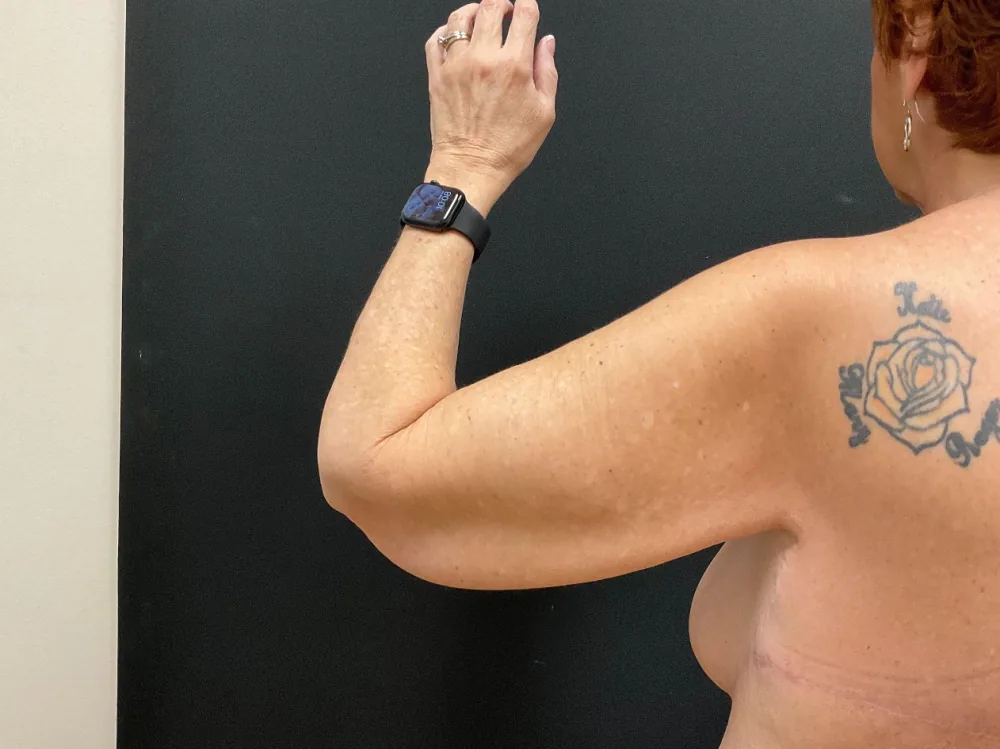 Arm Lift (Brachioplasty) before — Dr. John Aker