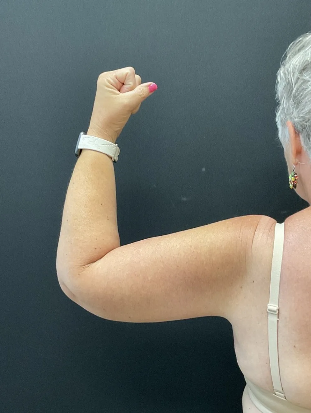 Arm Lift (Brachioplasty) after — Dr. John Aker