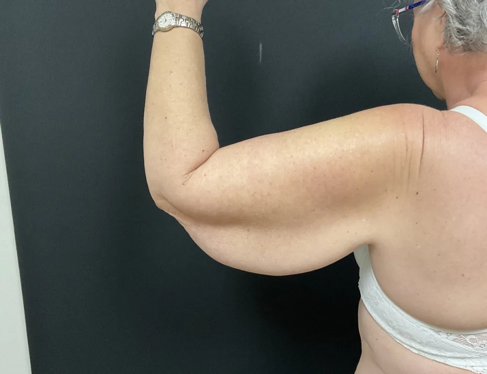 Arm Lift (Brachioplasty) before — Dr. John Aker