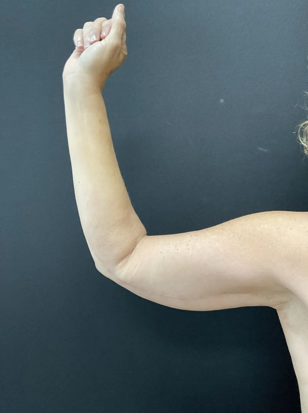 Arm Lift (Brachioplasty) after — Dr. John Aker