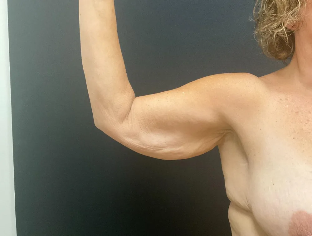 Arm Lift (Brachioplasty) before — Dr. John Aker
