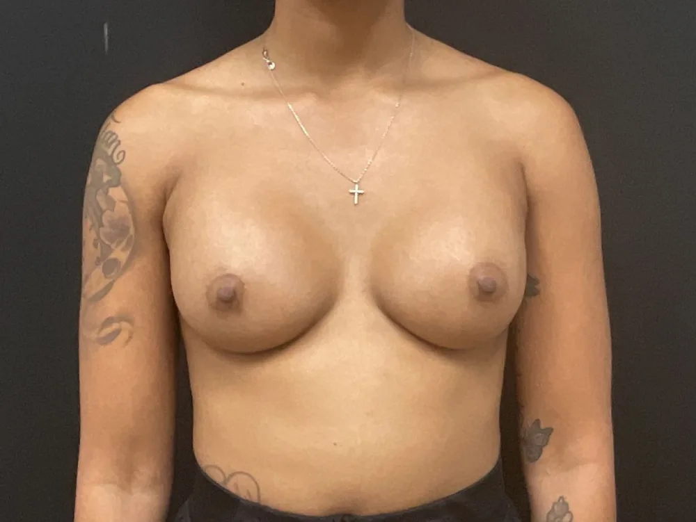 Breast Augmentation after — Dr. John Aker