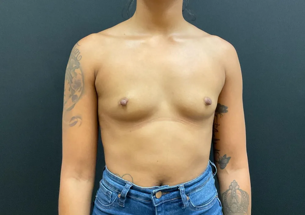 Breast Augmentation before — Dr. John Aker
