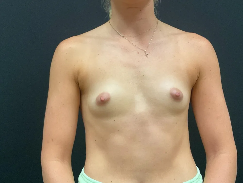 Breast Augmentation before — Dr. John Aker