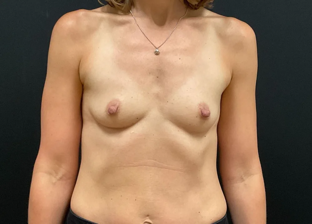 Breast Augmentation before — Dr. John Aker
