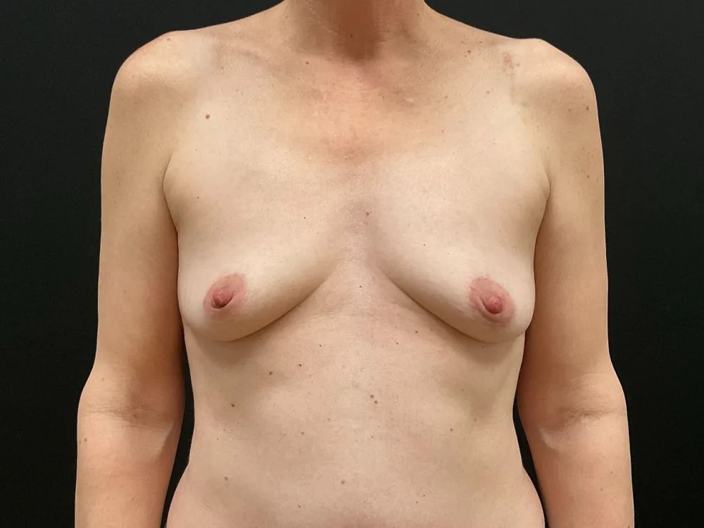 Breast Augmentation before — Dr. John Aker