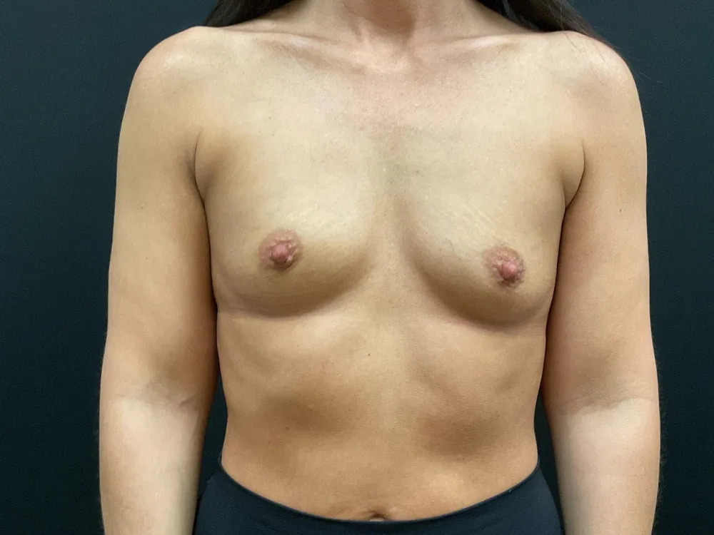 Breast Augmentation before — Dr. John Aker