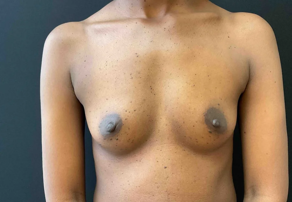 Breast Augmentation before — Dr. John Aker