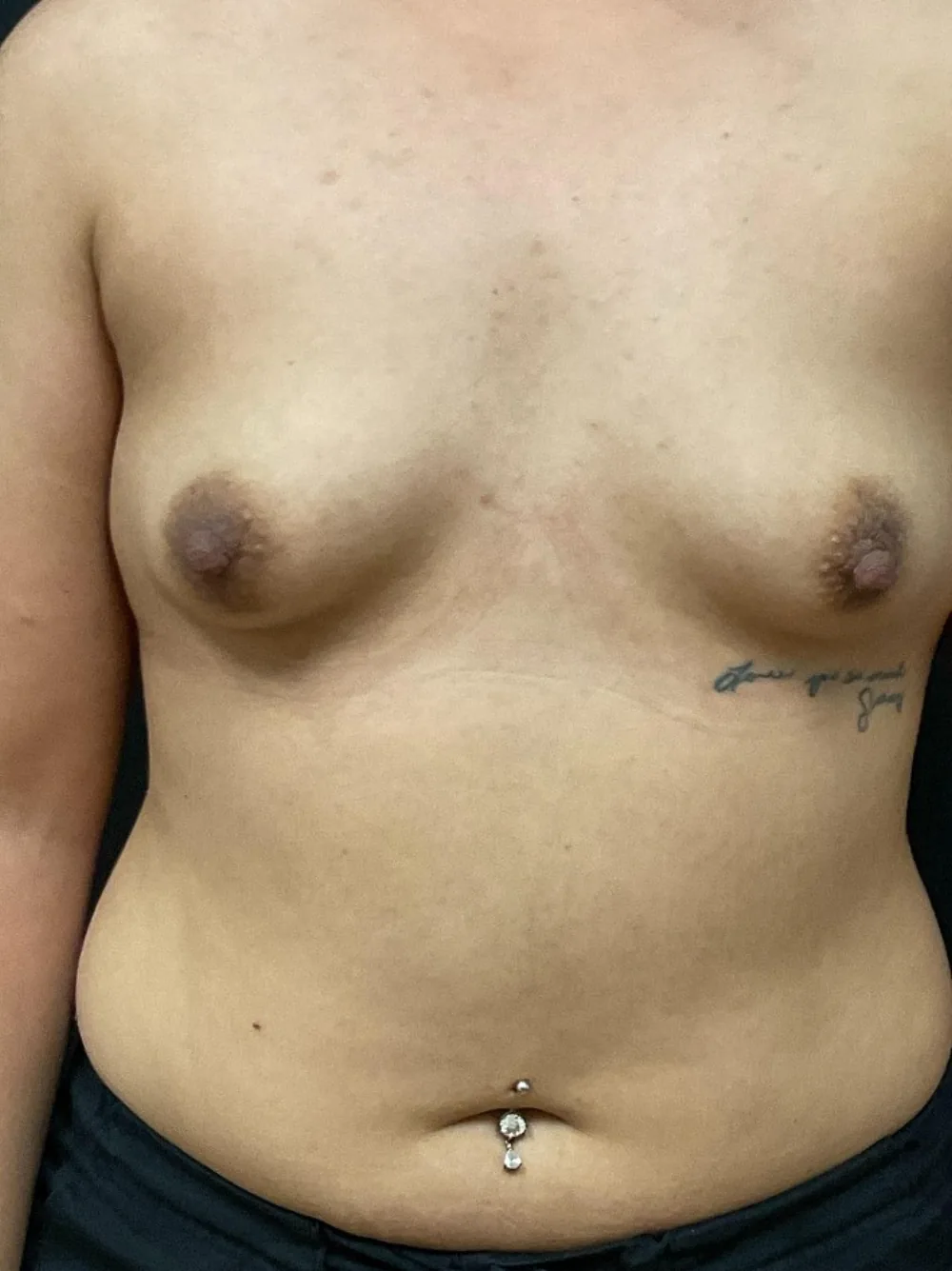 Breast Augmentation before — Dr. John Aker