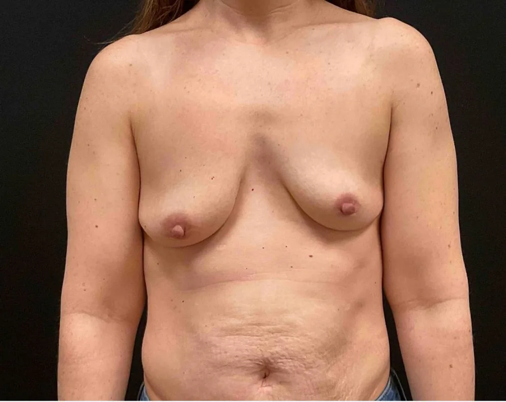 Breast Lift before — Dr. John Aker