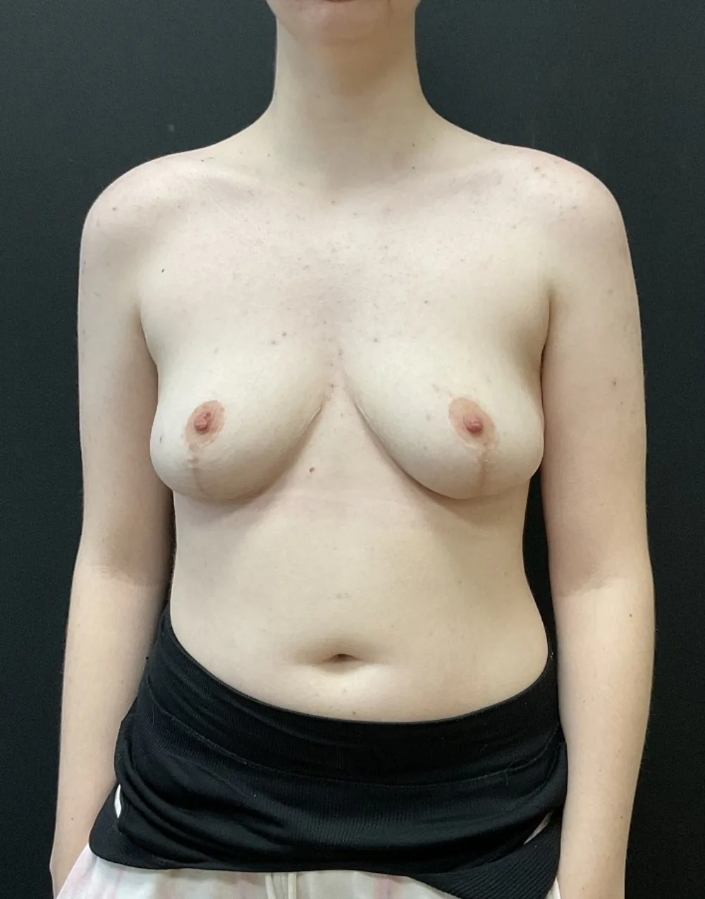 Breast Reduction after — Dr. John Aker