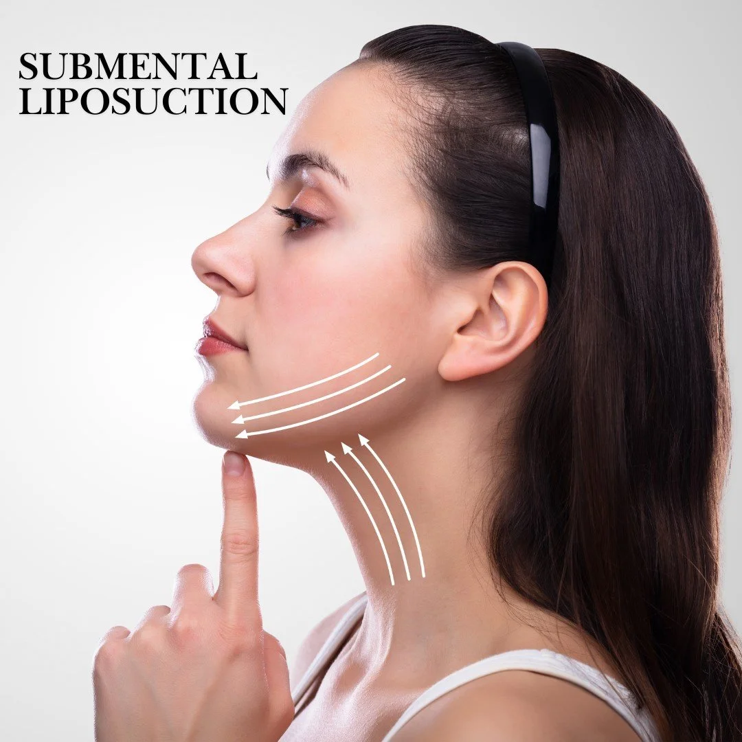 Liposuction